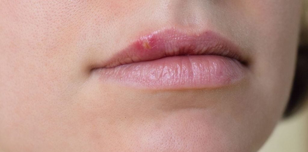 Síntomas del herpes oral Lea este artículo en línea BFH