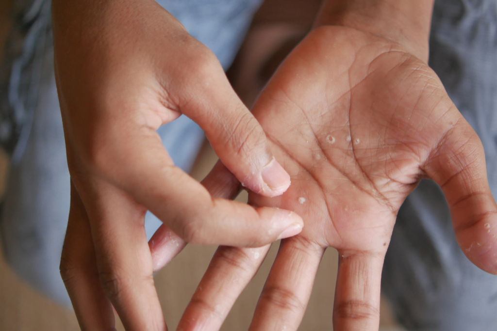 mejor crema para el eczema dishidrótico