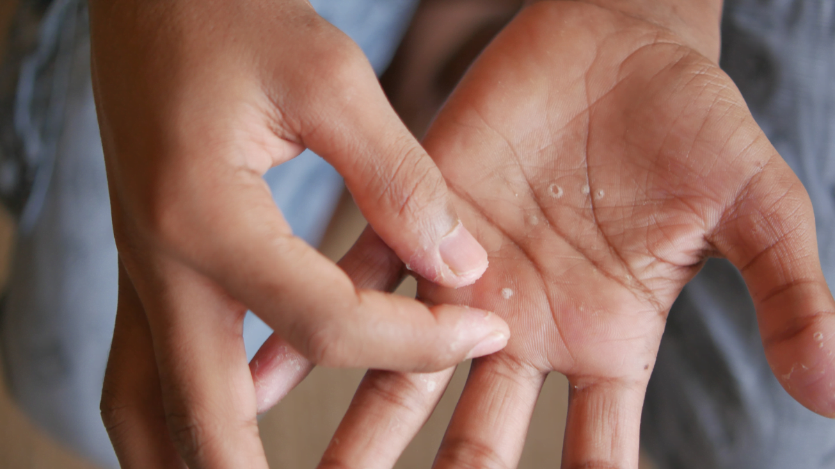 best cream for dyshidrotic eczema