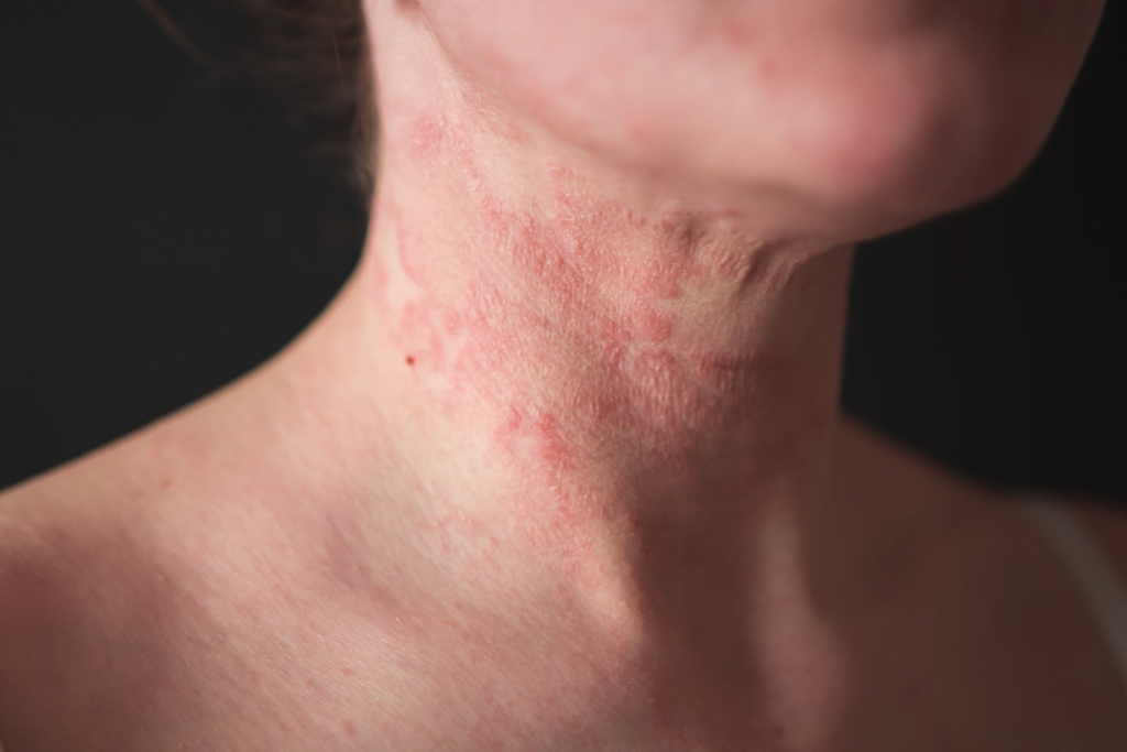 dyshidrotic eczema and autoimmune disease