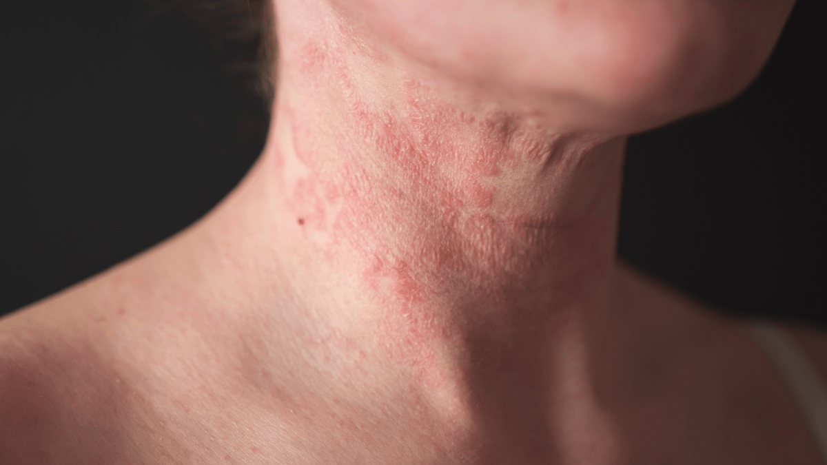 dyshidrotic eczema and autoimmune disease