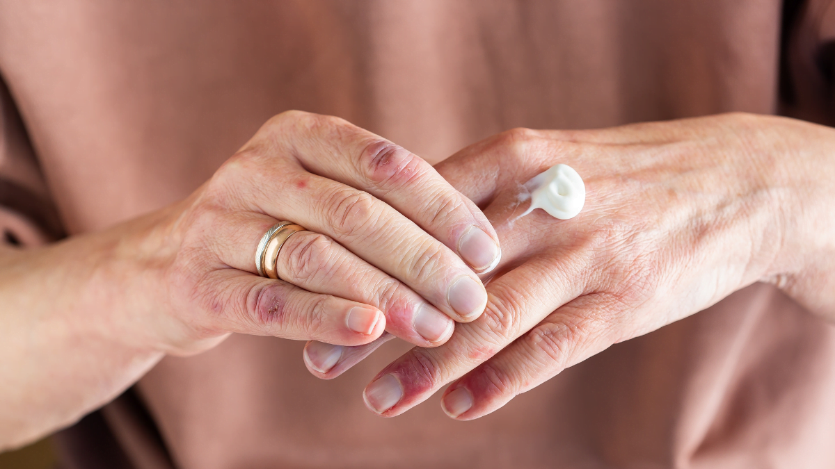 palmoplantar pustulosis