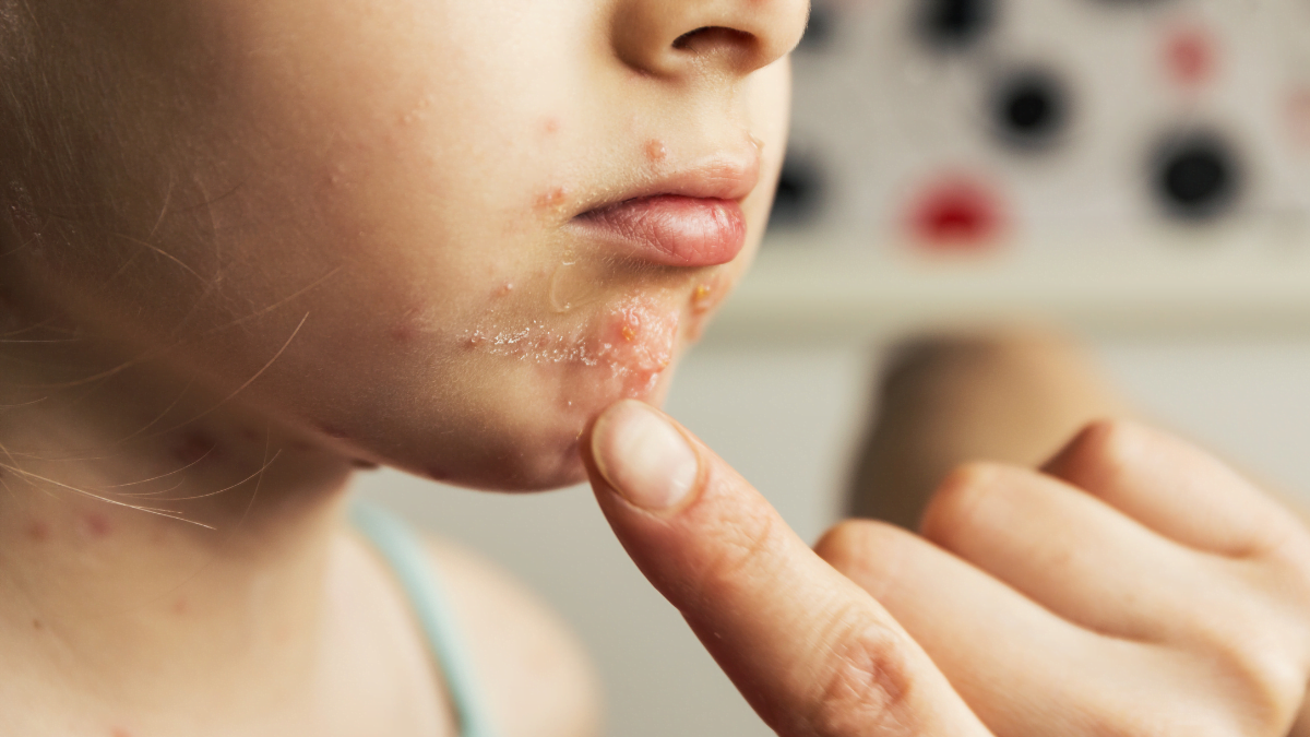 similar to chicken pox