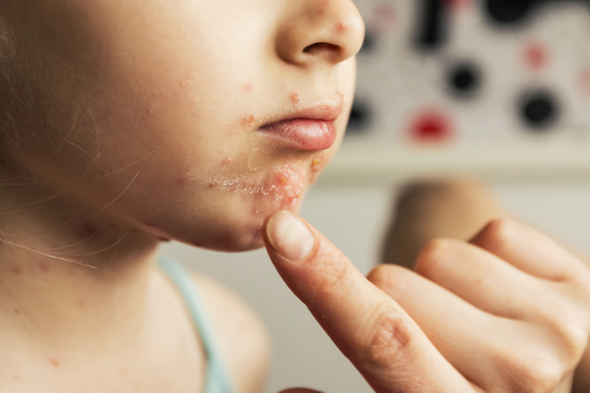 Chickenpox vs. Shingles: Understanding the Connection and Differences ...