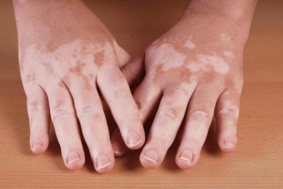 Pioglitazone for Vitiligo