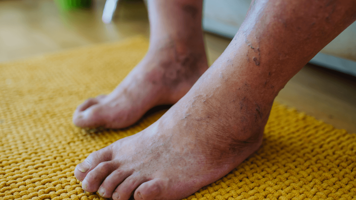 Diabetic Foot Ulcer