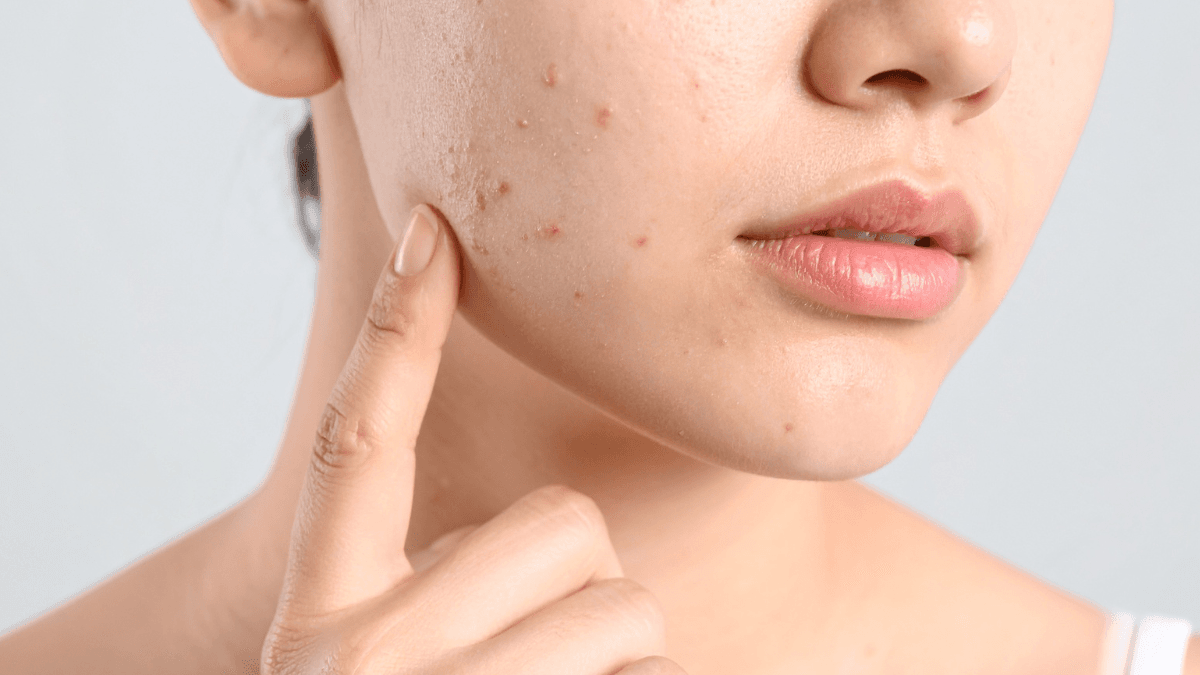 Doxycycline Hyclate Acne